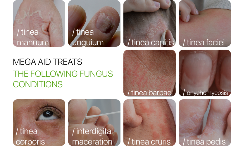 What types of fungal infections does Mega Aid treat