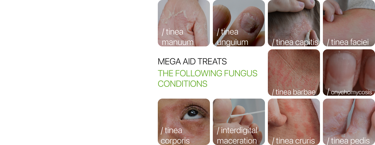 What types of fungal infections does Mega Aid treat