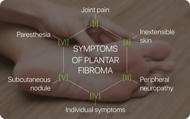 symptoms of plantar fibroma